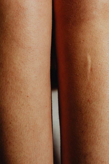 two brown hairy spots are on a woman's legs