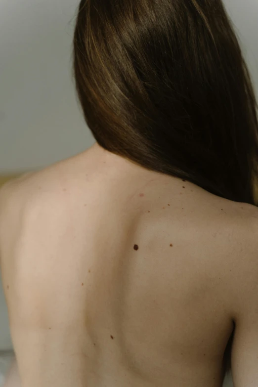 back of a woman with spots on her skin