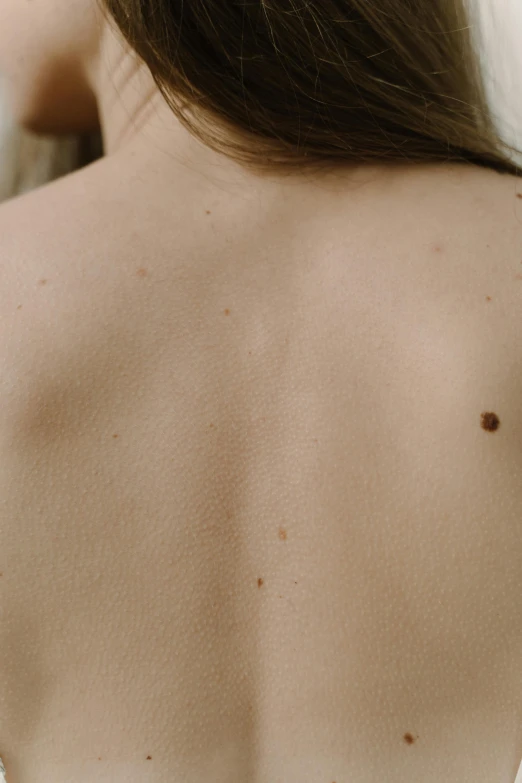 this woman has brown spots on her back