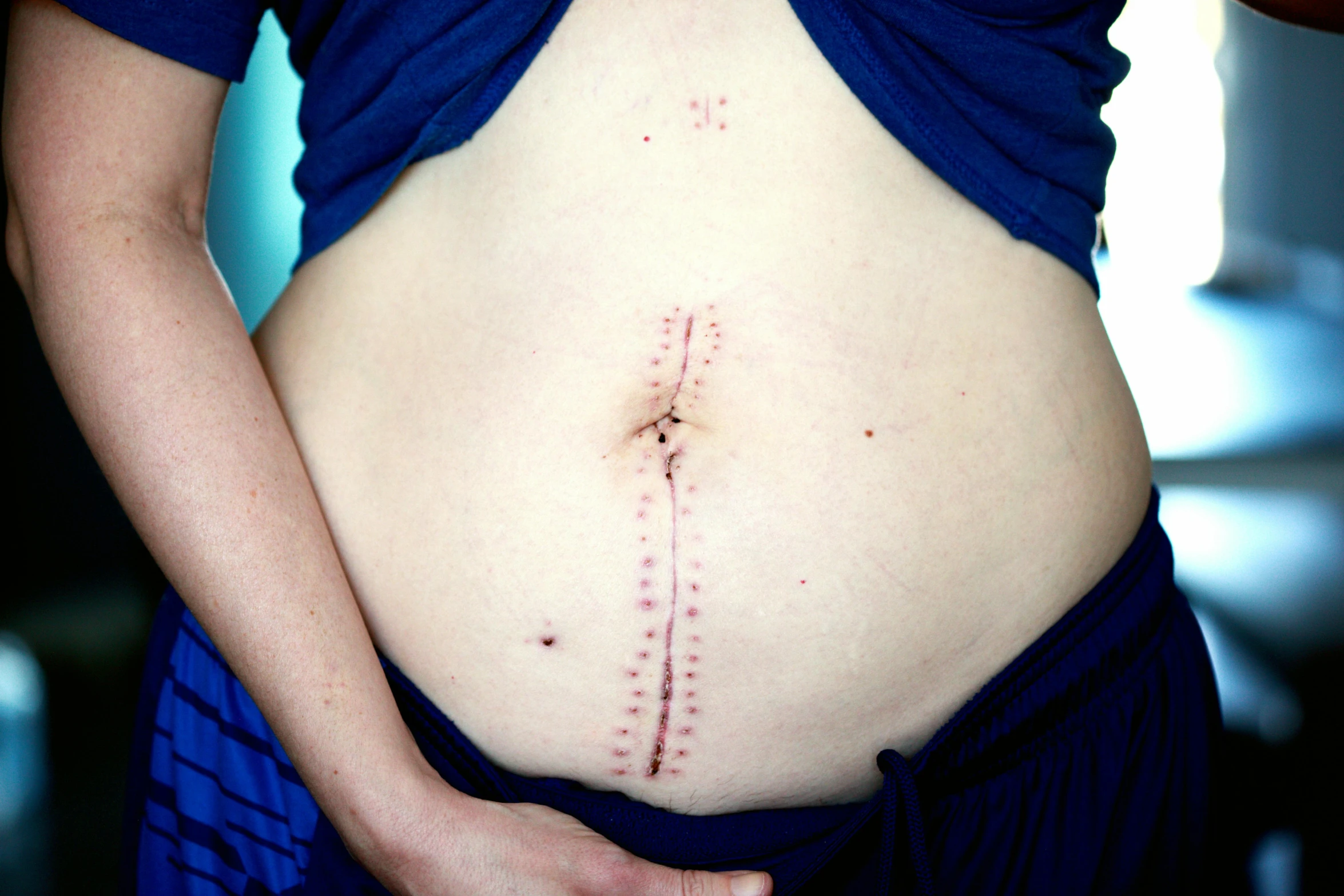 a woman's stomach with a line drawn on it