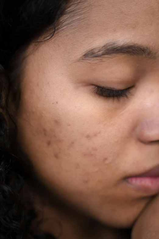 a close - up of a woman's face has freckled dark, acne