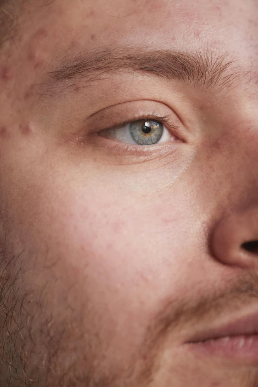 a close - up of an adult male with spotty hair