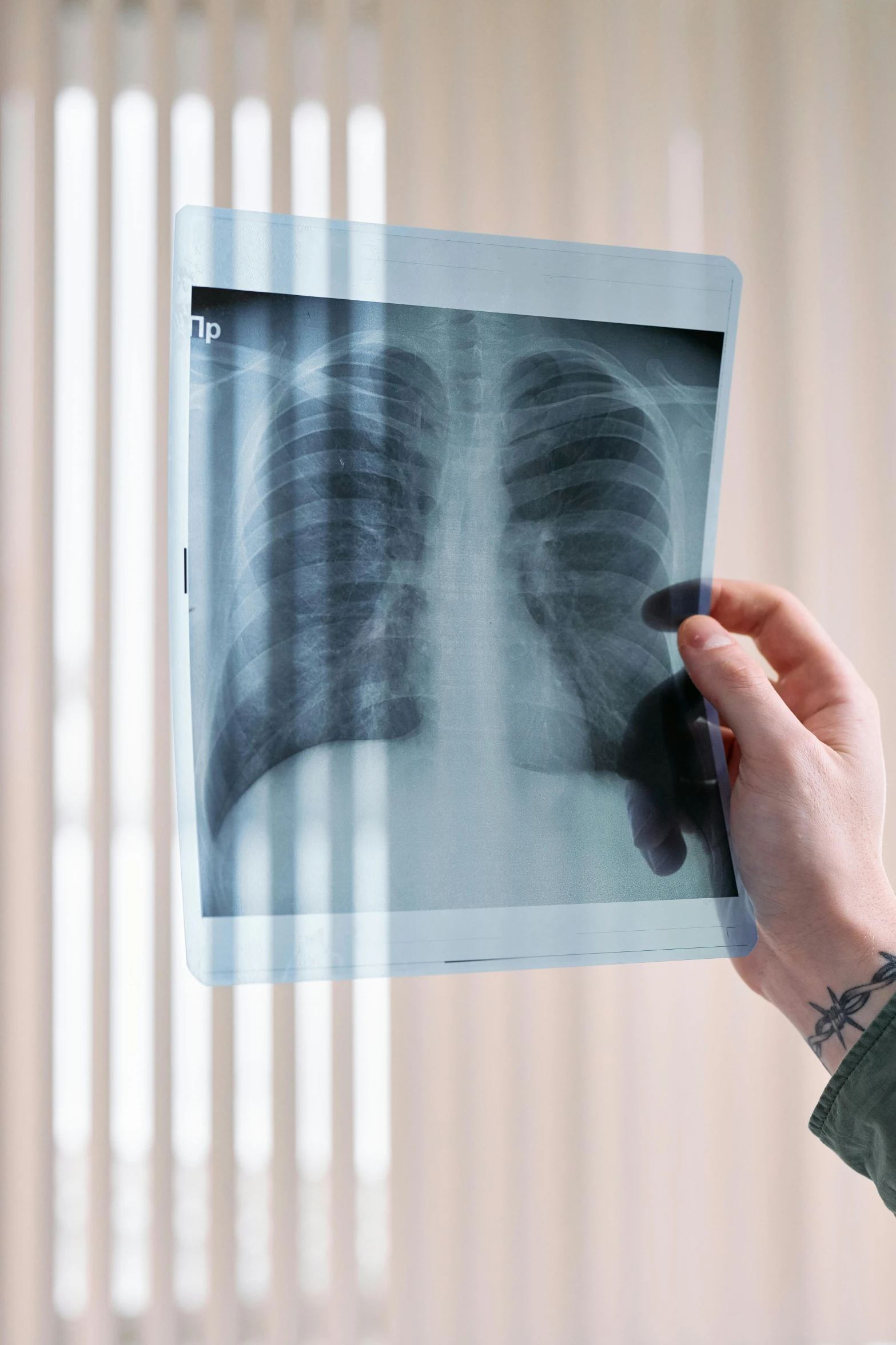 a person holding up a radiograph showing ribs