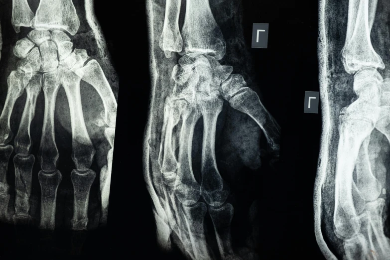 a pair of bones showing the normal, and median metators