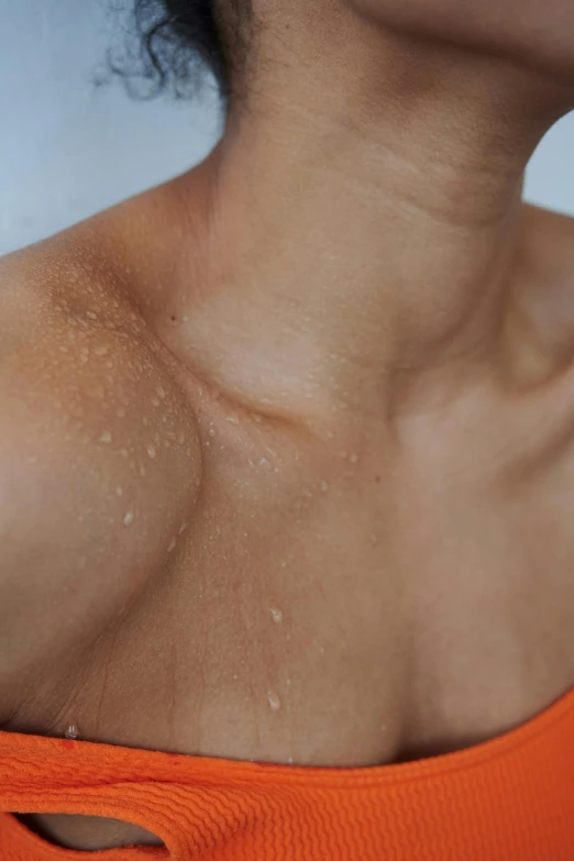 a woman wearing an orange top has sunburnes on her chest