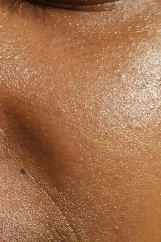 the right side of a woman's face with acne and other things underneath it