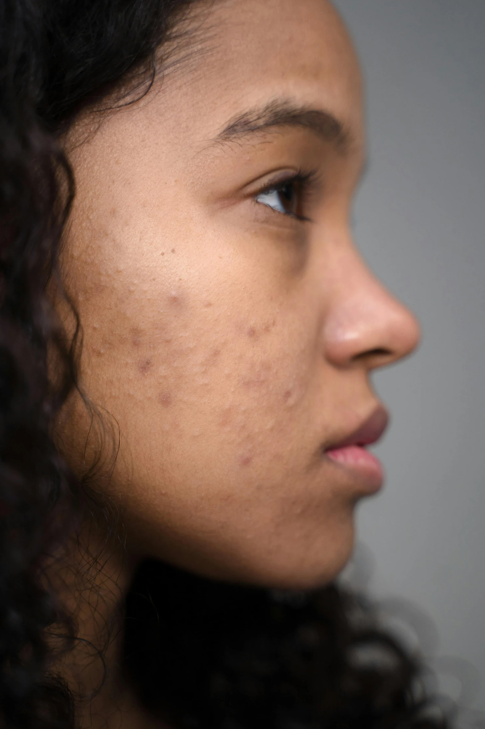 a closeup of a woman with acne on her face