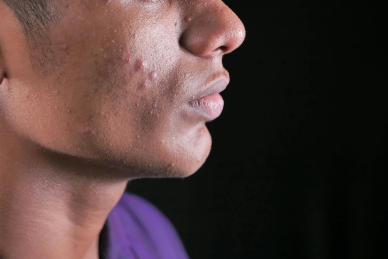 a close up s of the side of a person's face with acne on his right side