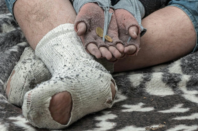 the hands and feet of a man with his injured feet