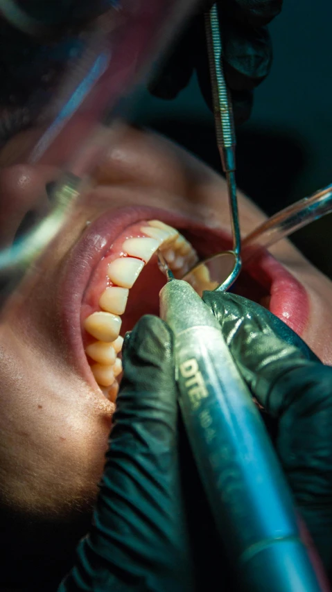 a person with a black glove and earpieces in their hands, while the dentist is preparing to open a tooth