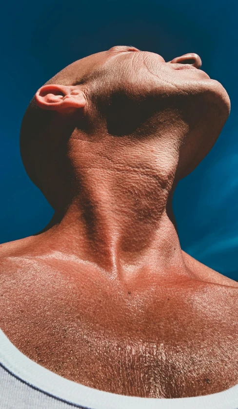 a man has a sunburnd back and neck