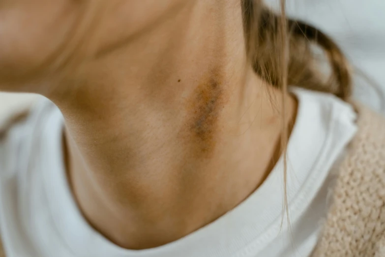 a woman with a brown streak on her right neck