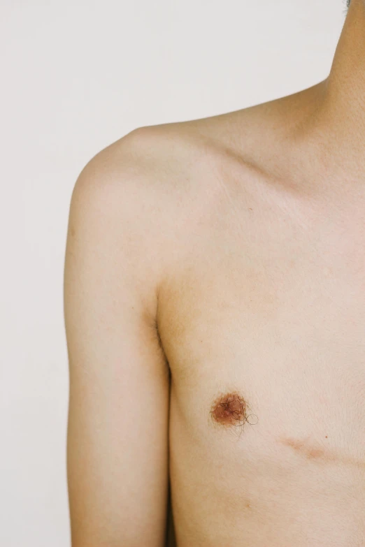 a person's bruised shoulder and small brown substance on it