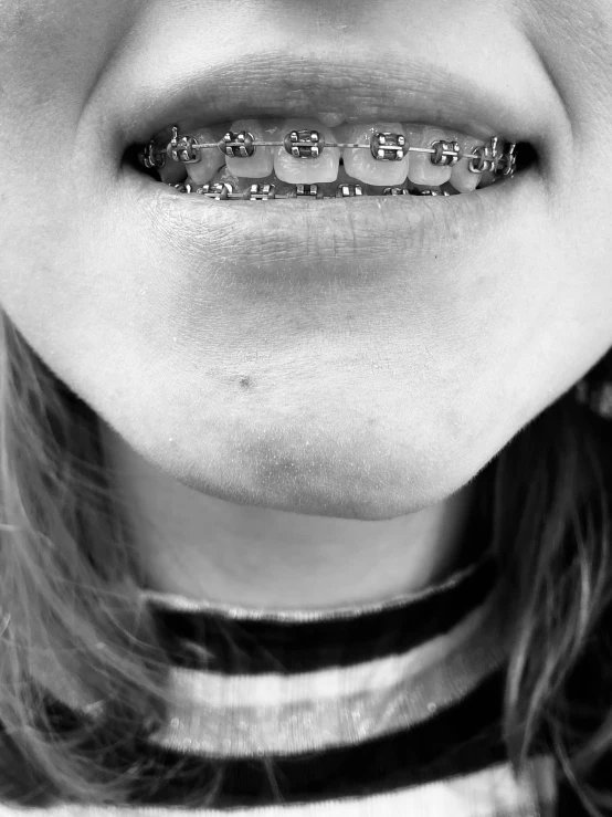 a close up s of a woman with ces on her teeth