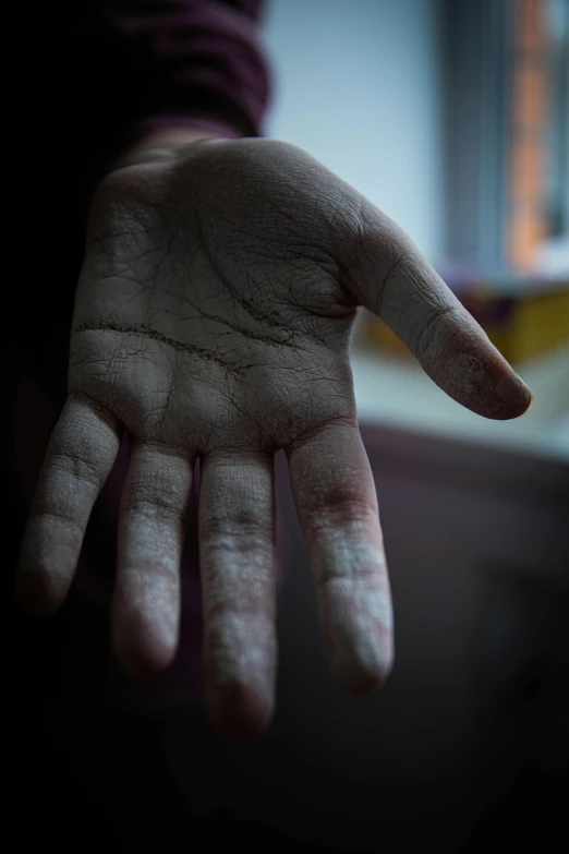 a hand with a bruised index finger and palm