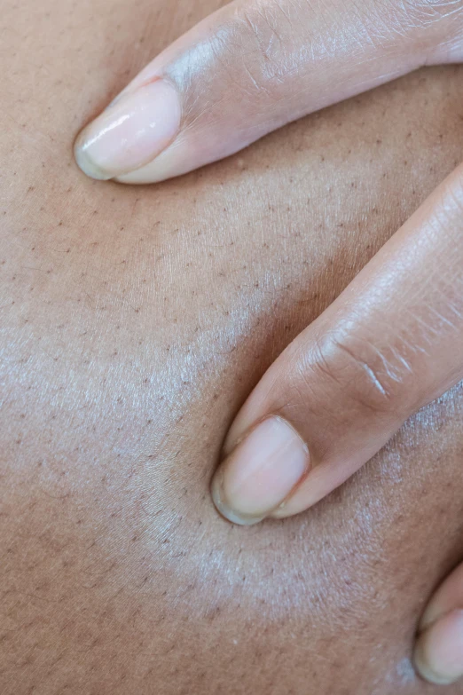 a person with acne on their skin showing marks