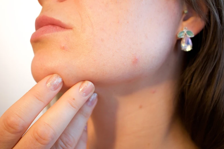 a close up of a person with a ring on their finger, a stipple, antipodeans, trypophobia acne face, with a pointed chin, hand on her chin, red cheeks