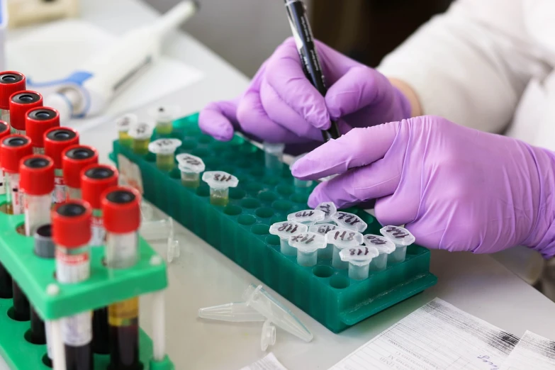 a person in purple gloves writing on a piece of paper, shutterstock, pathology sample test tubes, photograph credit: ap, viral photo, diagnostics