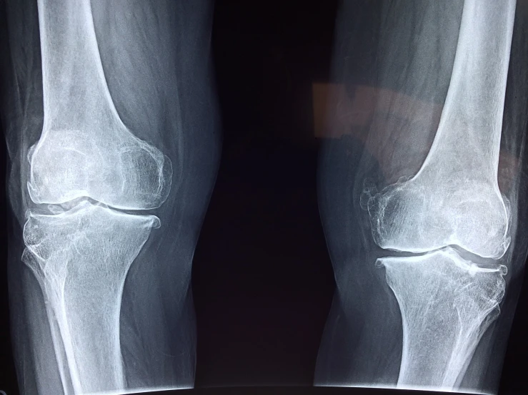 a pair of x - ray images of a knee, a picture, by Stefan Gierowski, pexels, pillars, stock photo, symmetrical balance, istockphoto