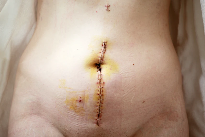 a fating woman with yellow stitches on her belly