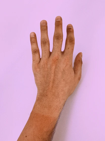 hand showing off the skin and skin cancer on its arm