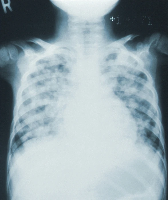 an x - ray shows ribs with no visible arms