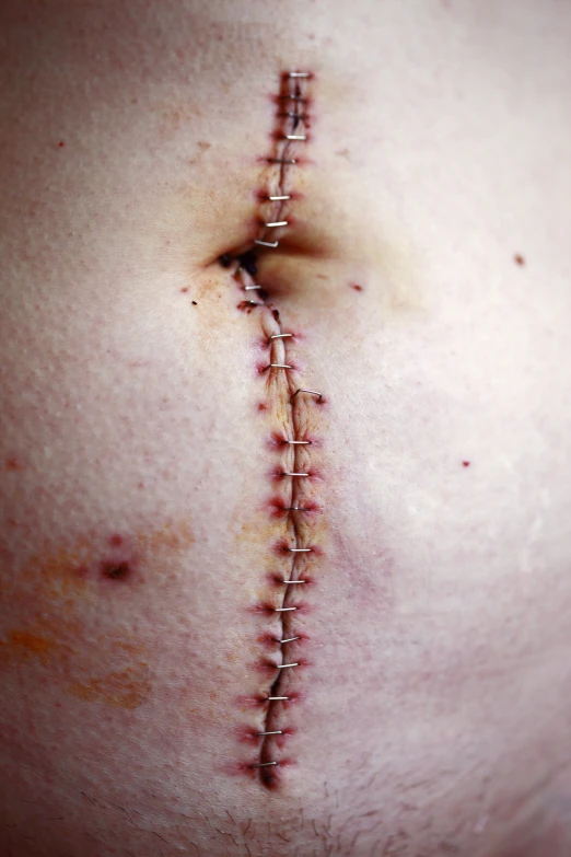 a woman with stitches on her chest with a side view of her stomach