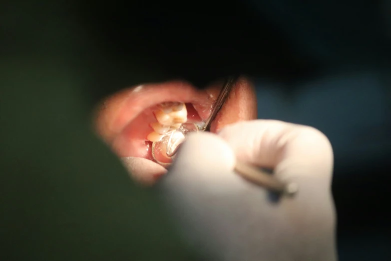 person getting dental on with a pair of small scissors