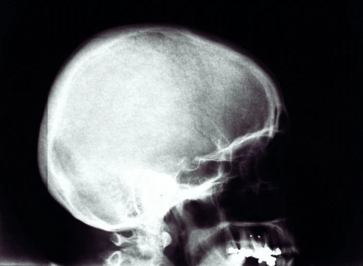 an image of the human skull in black and white