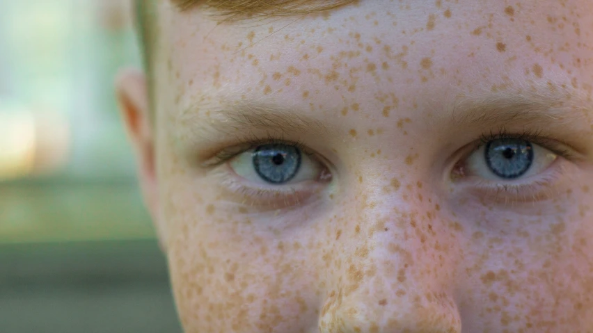 a person that is outside with freckled skin