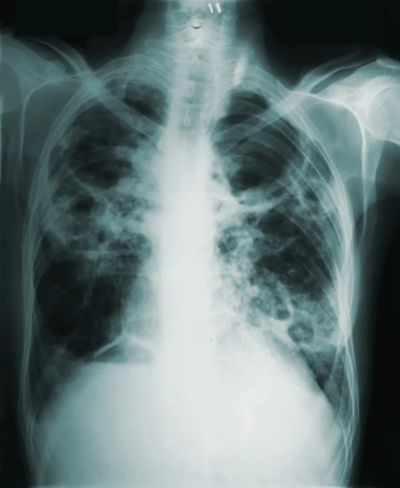 a black and white po of the lungs