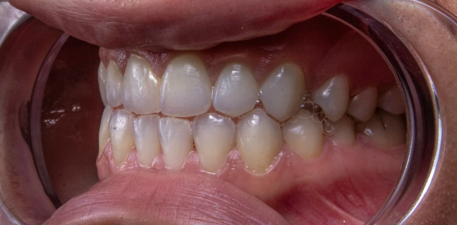 the teeth have their own plaque that are missing