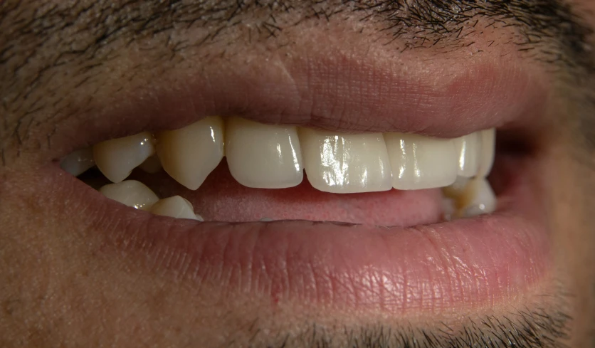 a man's teeth with ces and short tooth paste