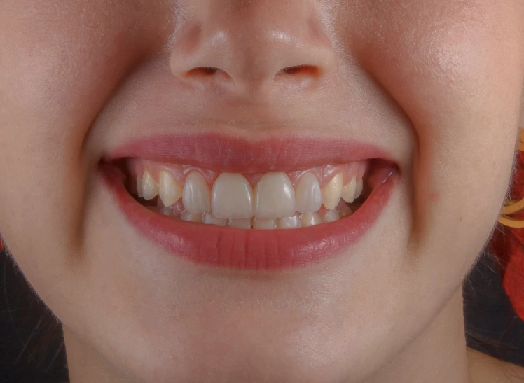 a young child's smile has missing teeth