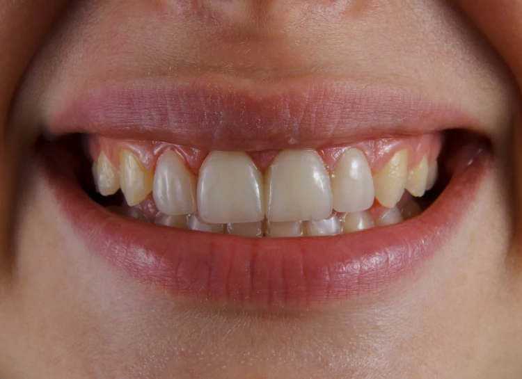 a person's smile with gums on it