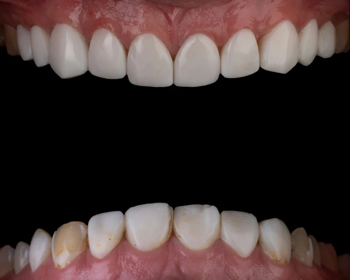 the lower and lower teeth are exposed with whitening