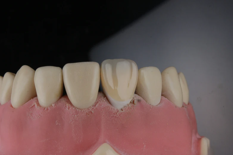 a close up of the teeth on a model of a woman's smile